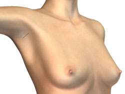 breast-v03[1]